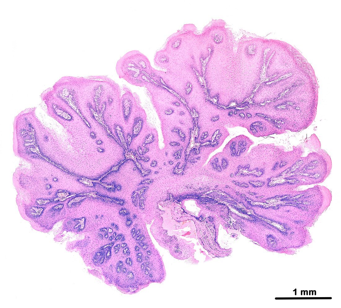 Soft palate papilloma, light micrograph
