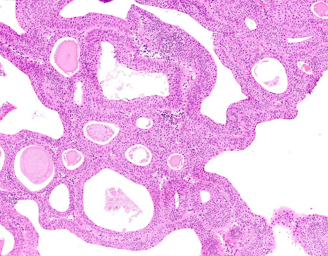 Bladder cancer, light micrograph
