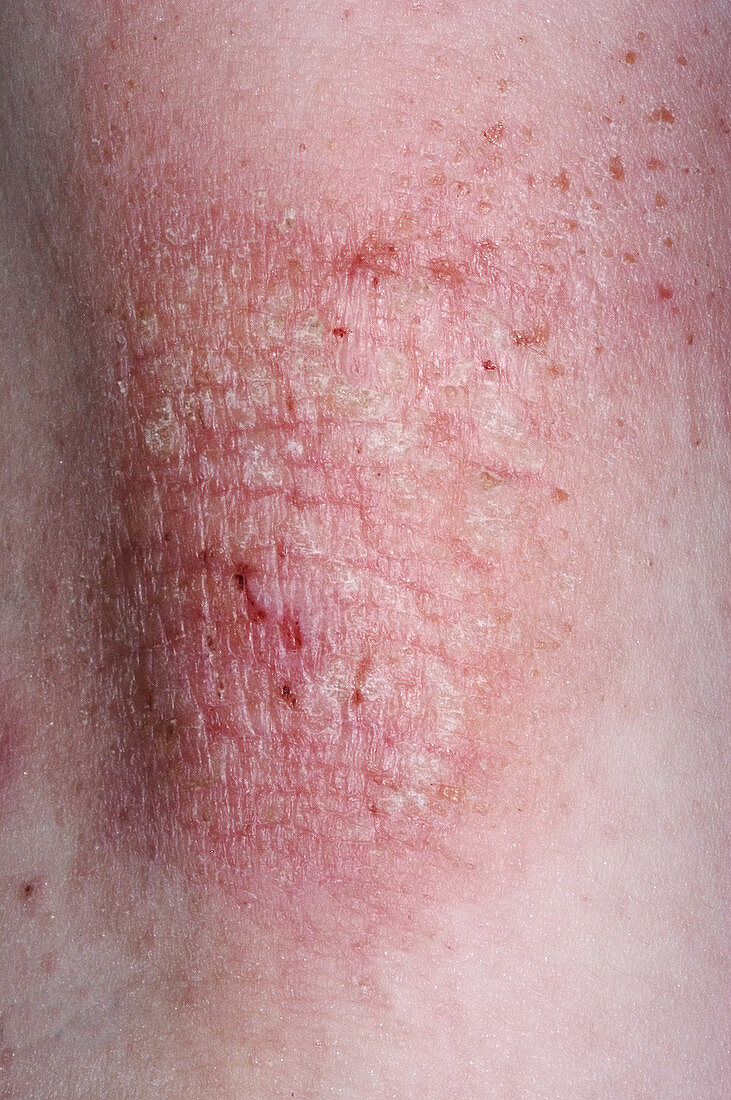Eczema skin rash on the knee