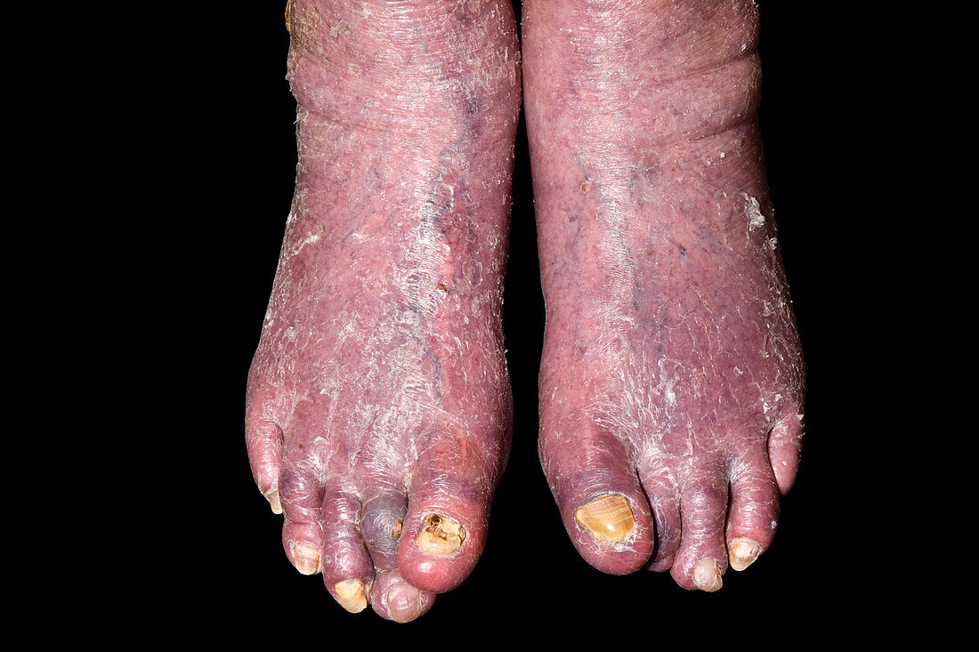 Feet in COPD