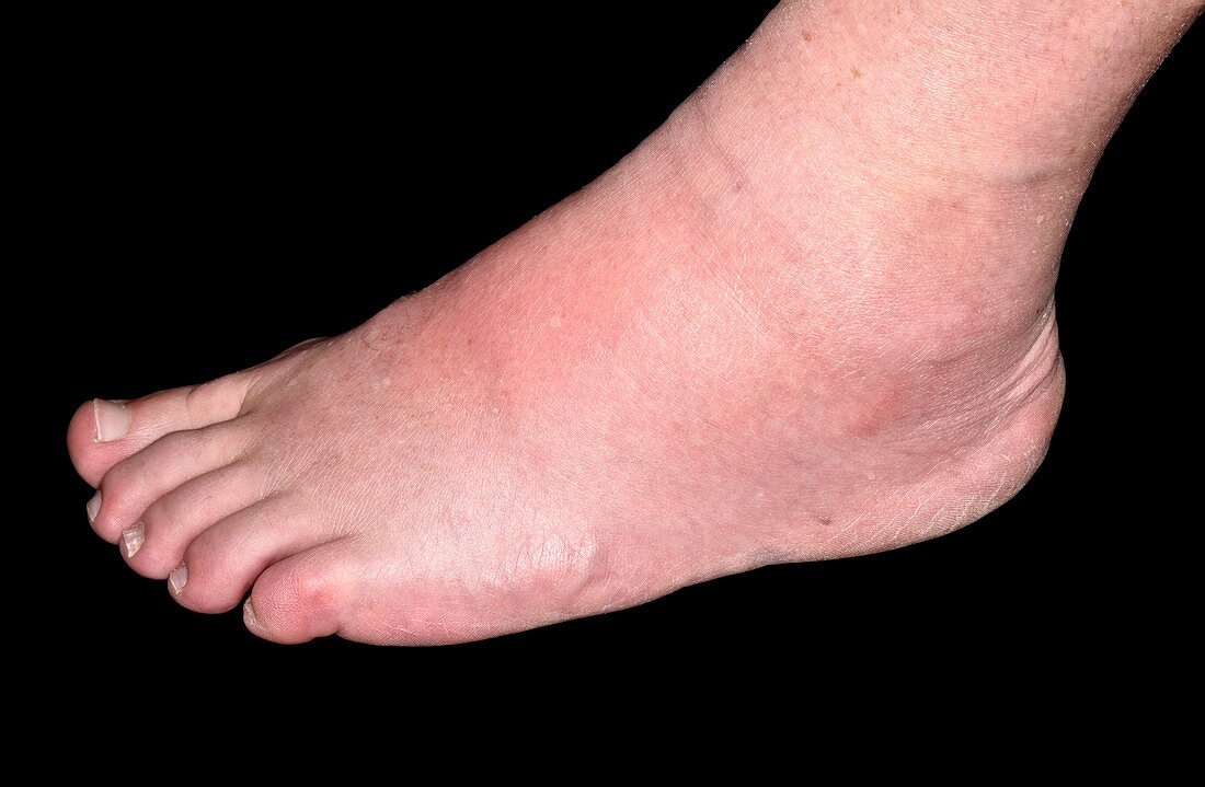 Gout of the foot