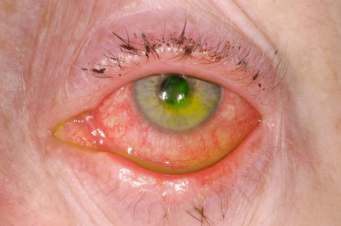 Dendritic ulcer in herpes simplex eye infection