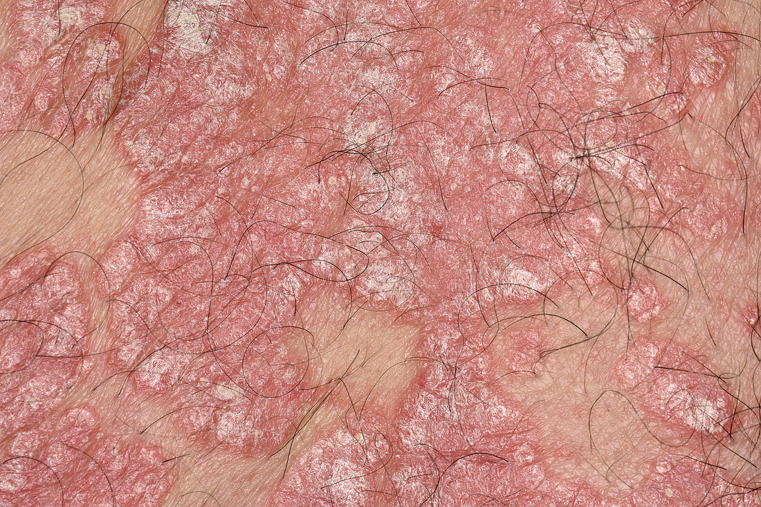 Plaque psoriasis