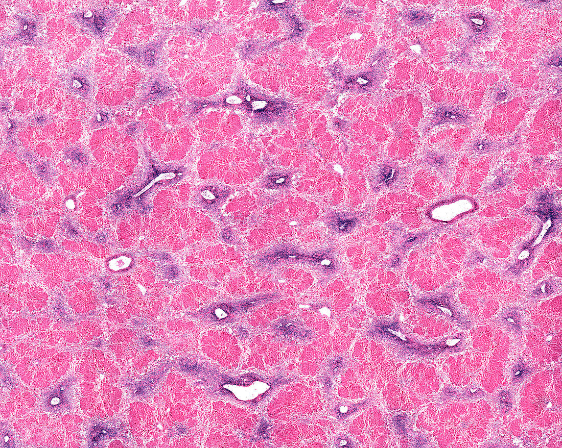 Liver necrosis, light micrograph