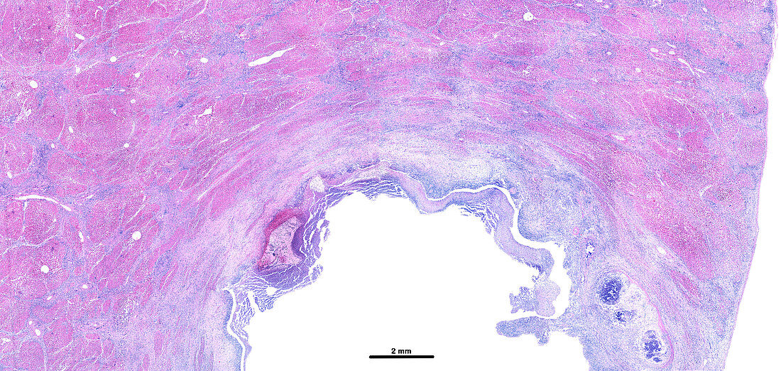 Pyogenic abscess of the liver, light micrograph