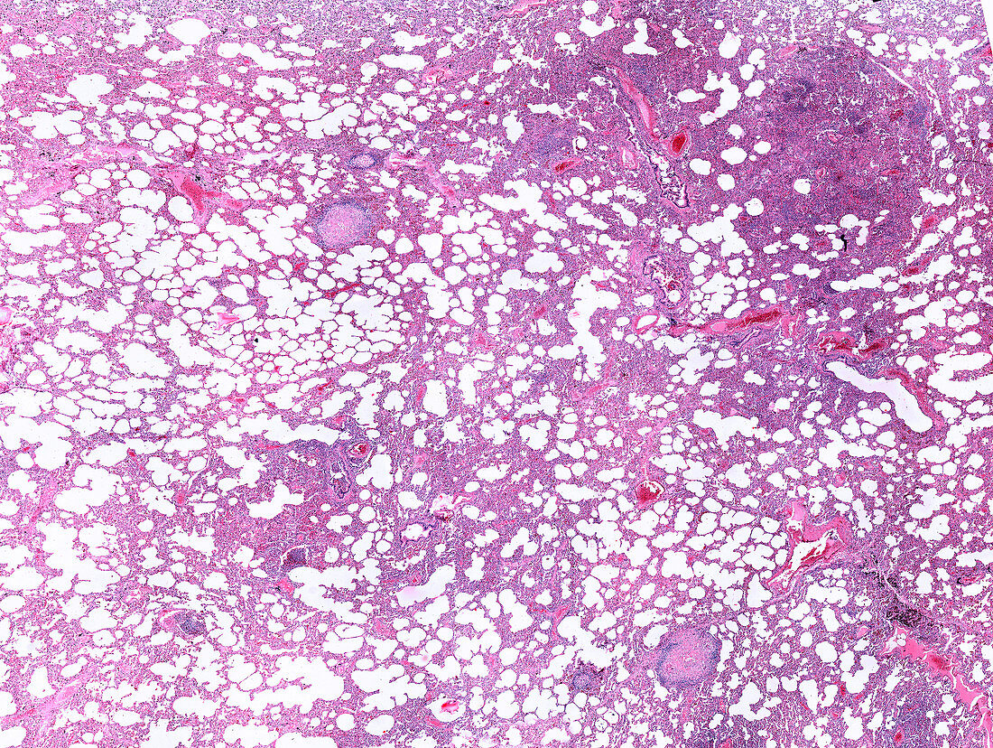 Human lung with miliary tuberculosis, light micrograph