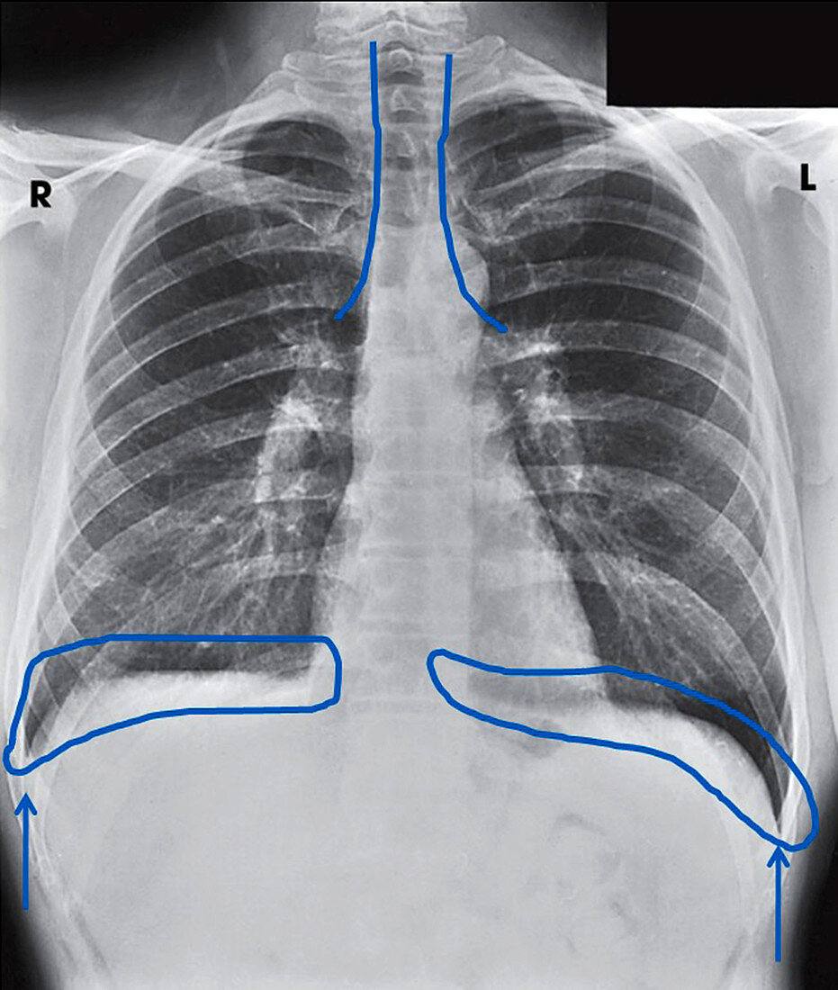 Chest X-Ray Showing Costophrenic Angles