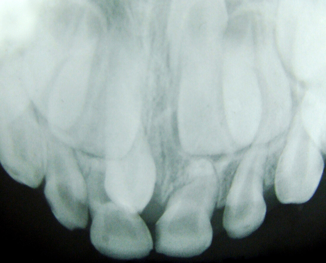 Supernumerary Teeth, X-Ray