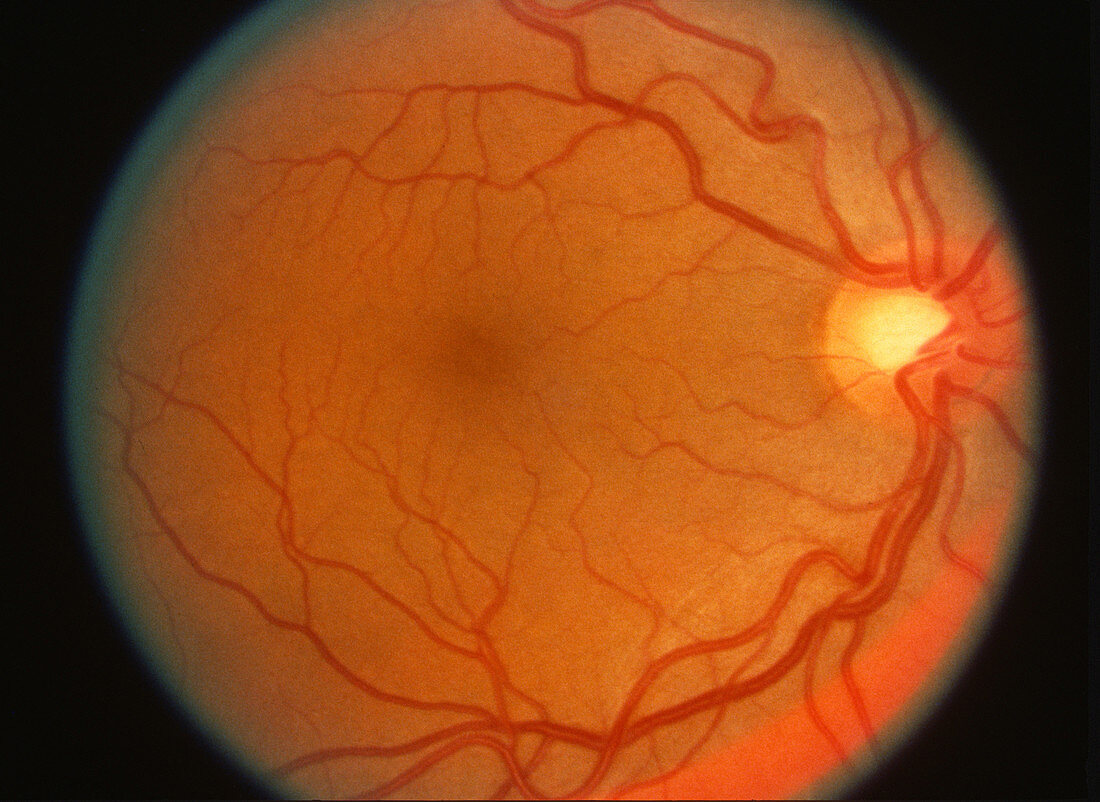 Retina and Optic Nerve