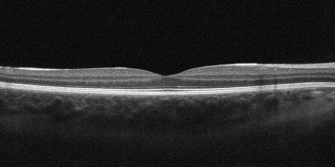 Spectral Domain optical coherence tomography of fovea