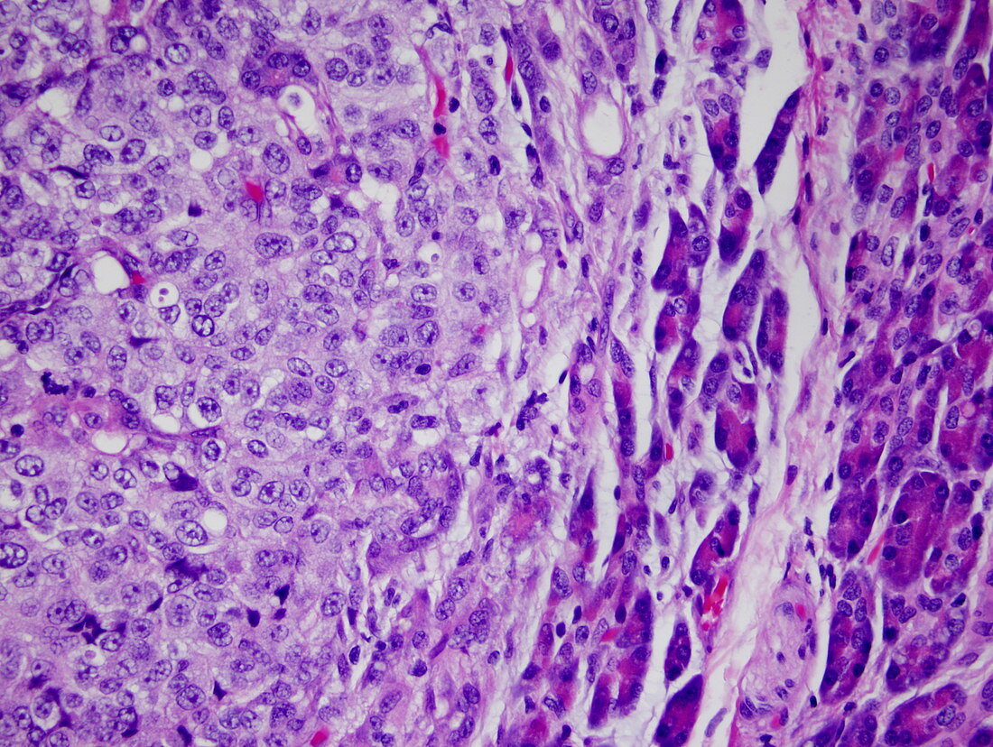 Metastatic melanoma cells