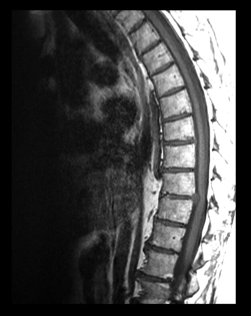 MRI Thoracic Disc Herniation