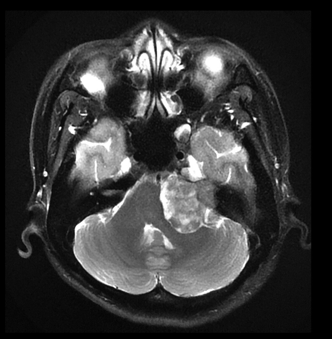 MRI Vestibular Schwannoma and Cavernous Sinus Lesion