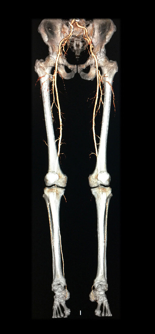 3D CTA Legs
