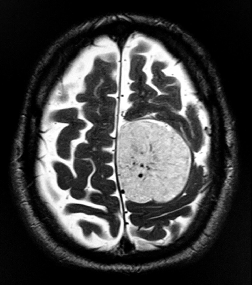 Parafalcine Meningioma MRI