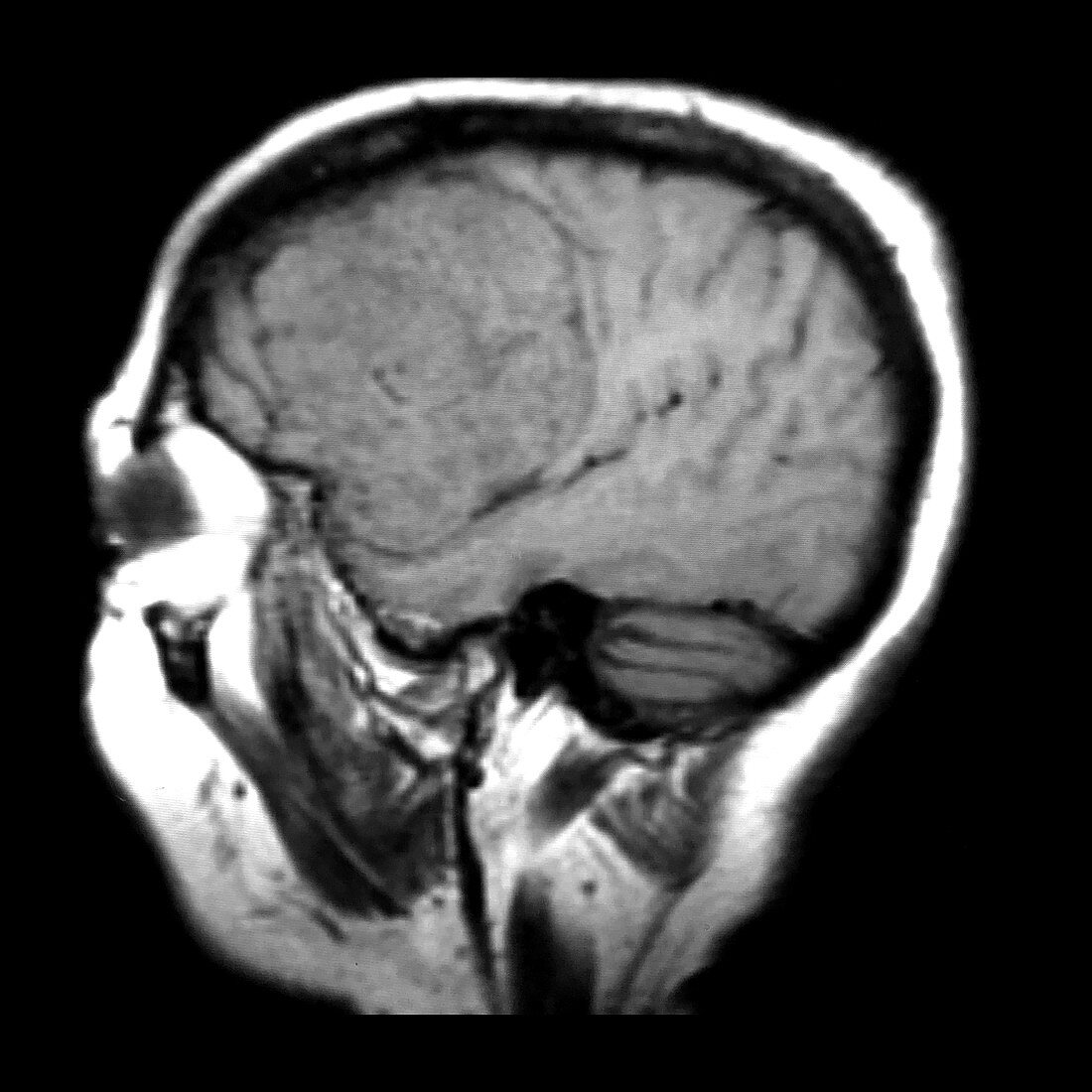 MRI Large Pterional Meningioma