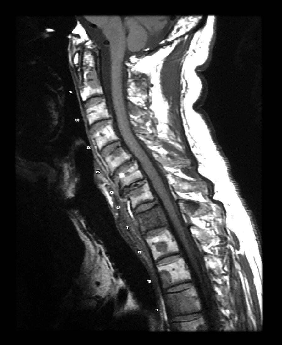 MRI Metastatic Lung Cancer to Cervical Thoracic Spine