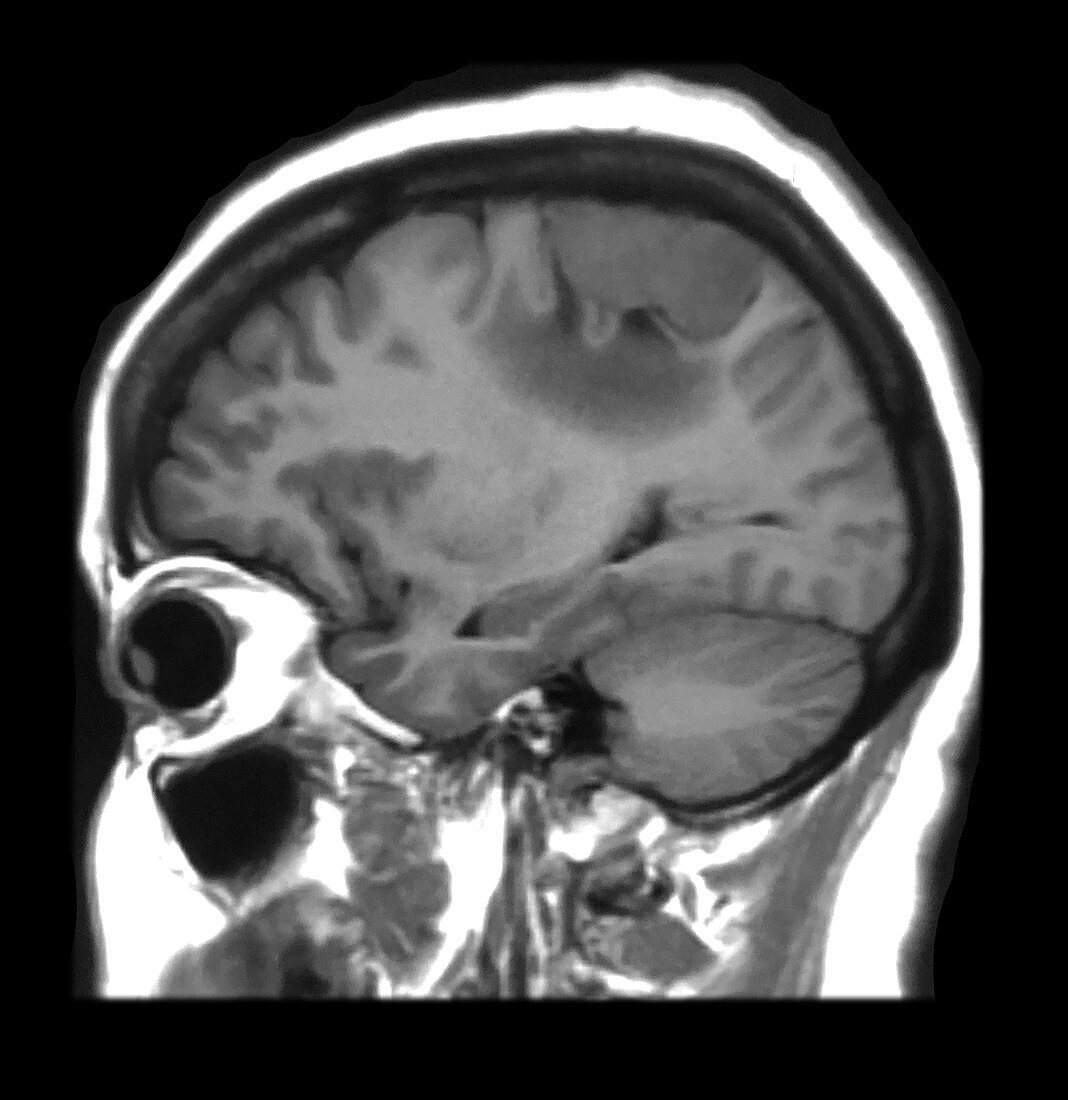 Vertex Meningioma MRI
