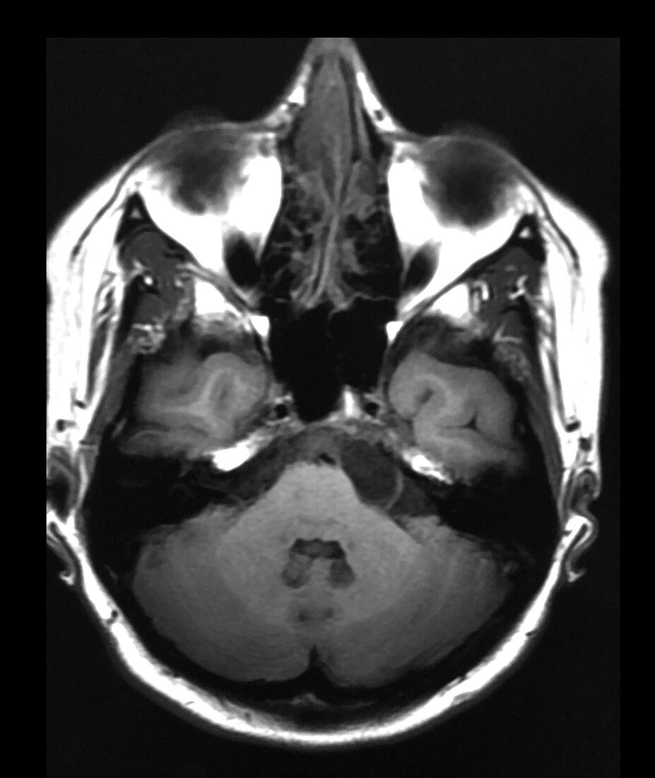 Epidermoid Tumour on MRI