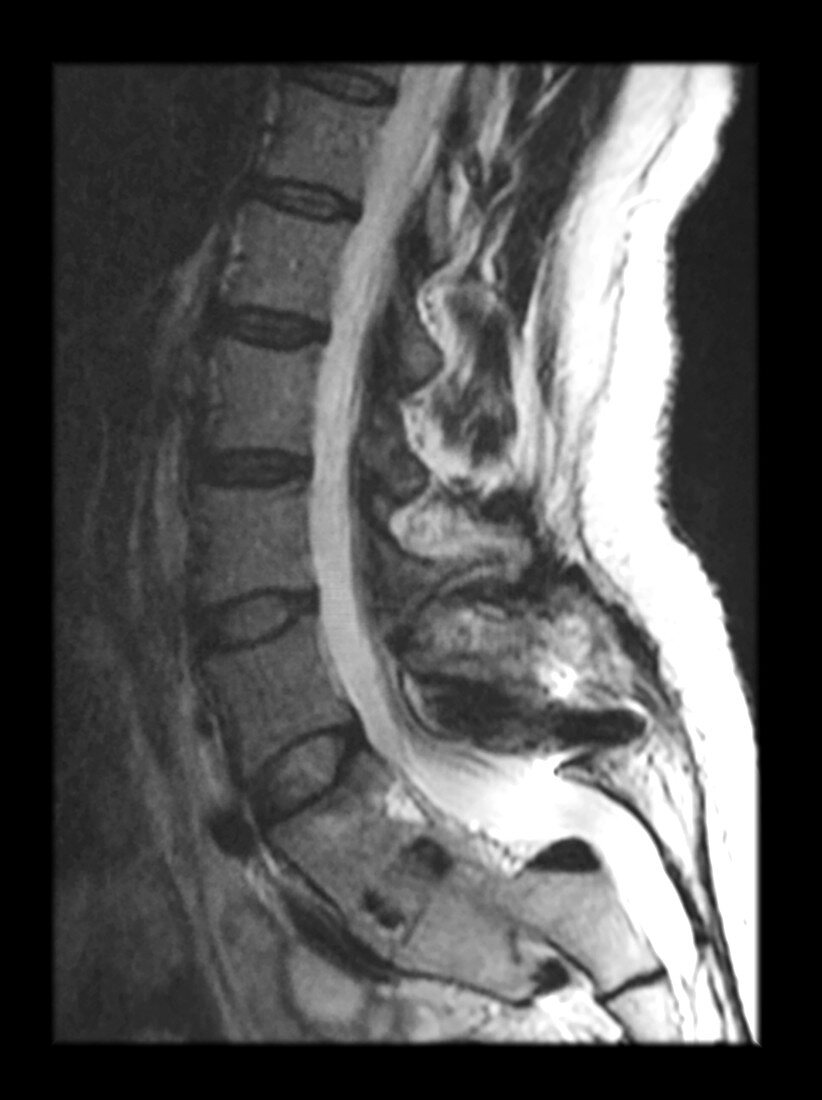MRI of Lumbar Spondylolisthesis and Post Surgical Changes