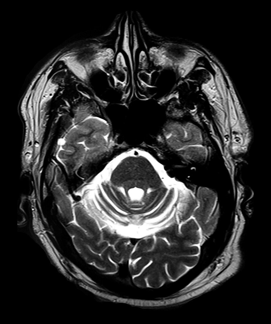 MRI Cerebellar Atrophy
