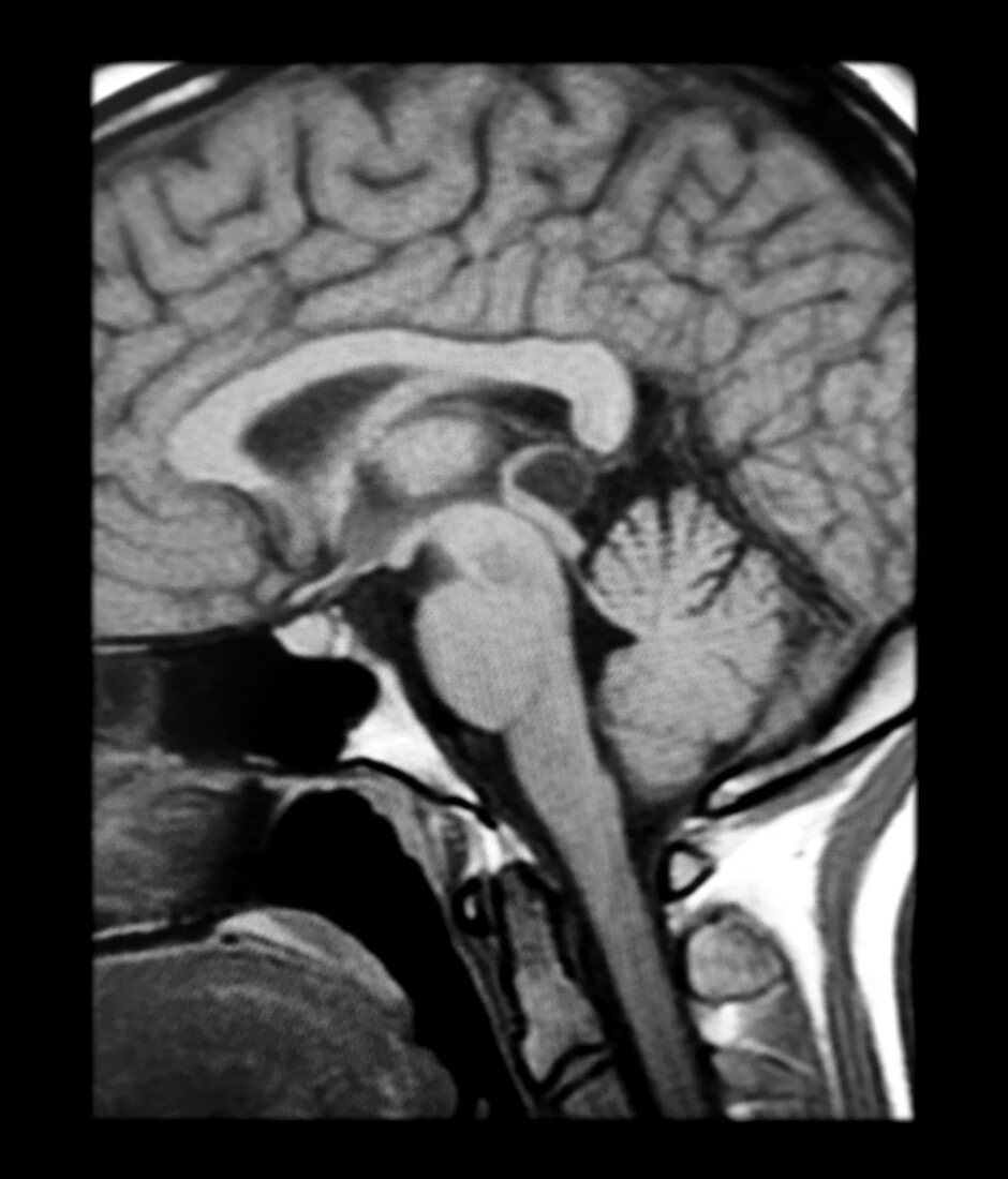 MRI Benign Pineal Cyst