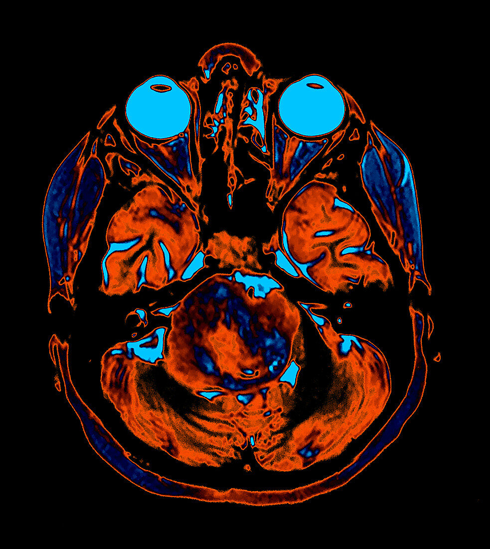 Enhanced MRI Brainstem Glioma