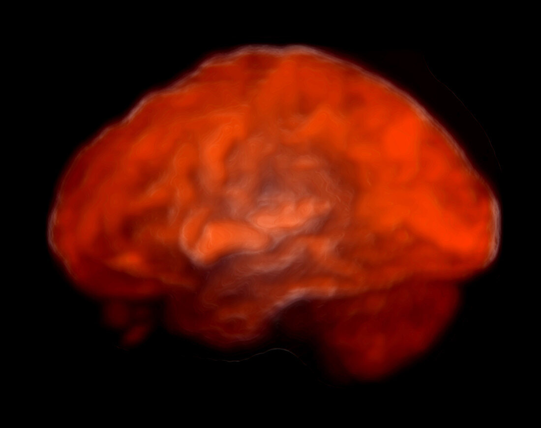 Enhanced PET Scan Brain