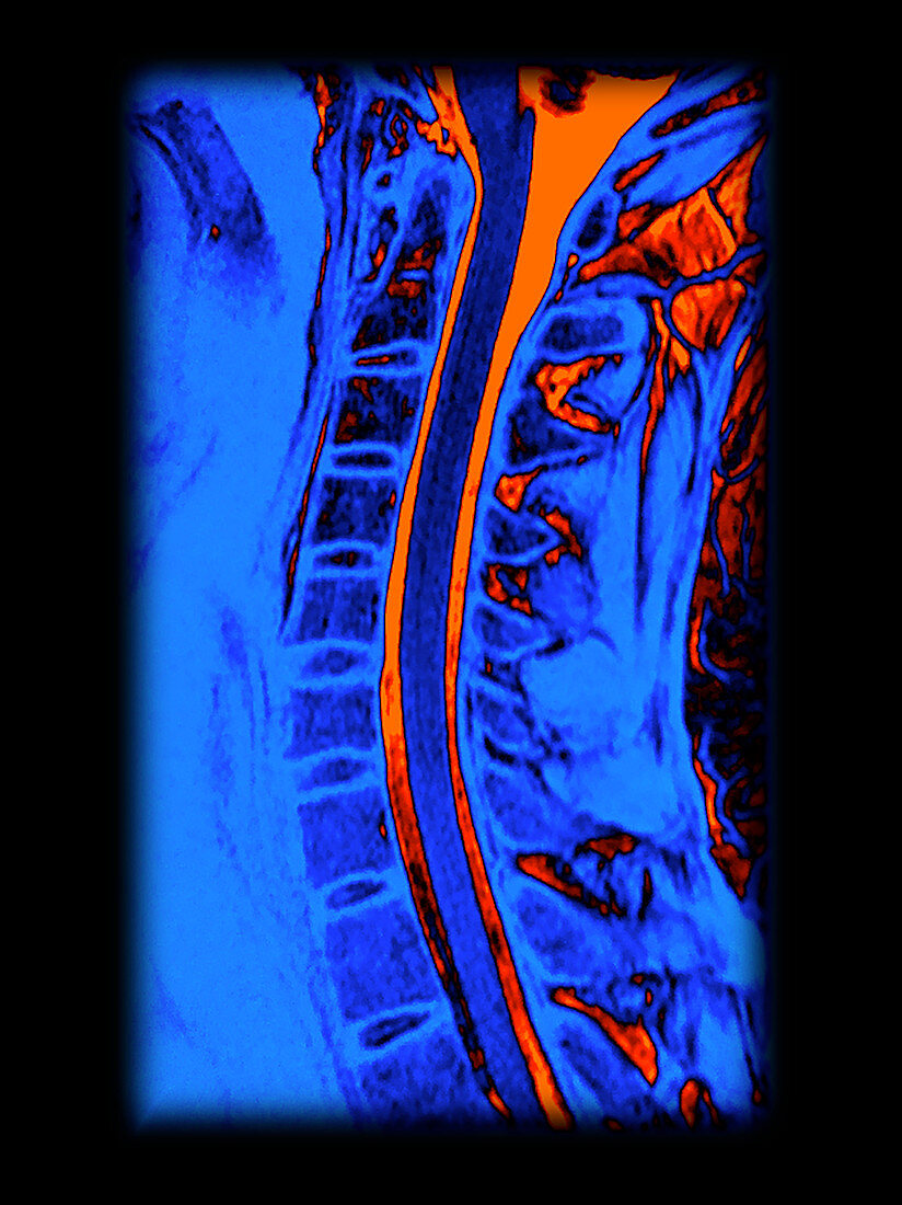 Enhanced Normal MRI Cervical Spine