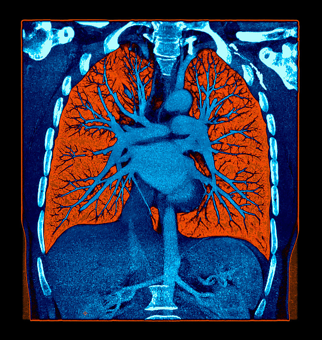 Enhanced CTA Chest