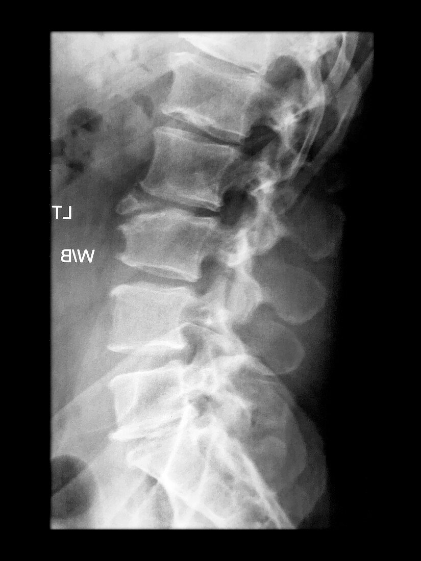 Limbus Vertebrae on X-ray