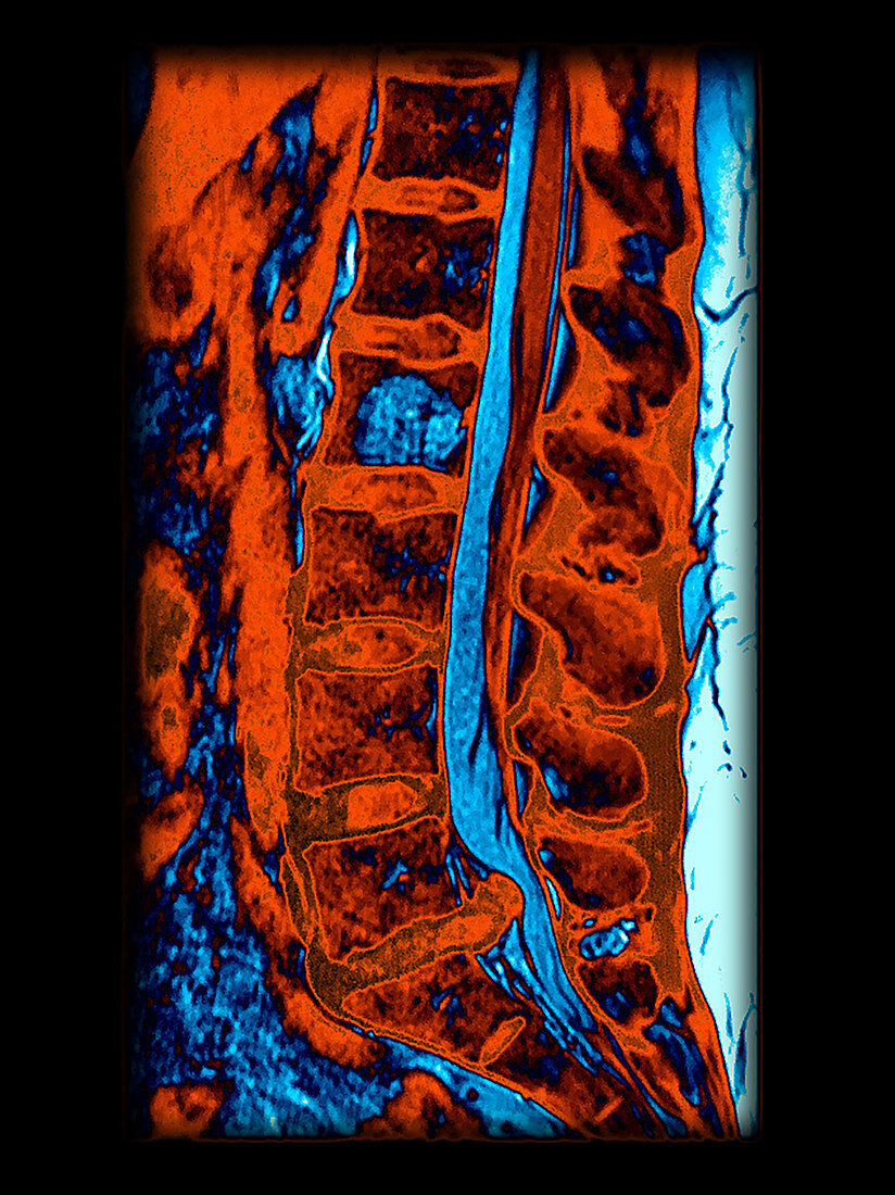 Enhanced MRI Large L5 S1 Disc Herniation