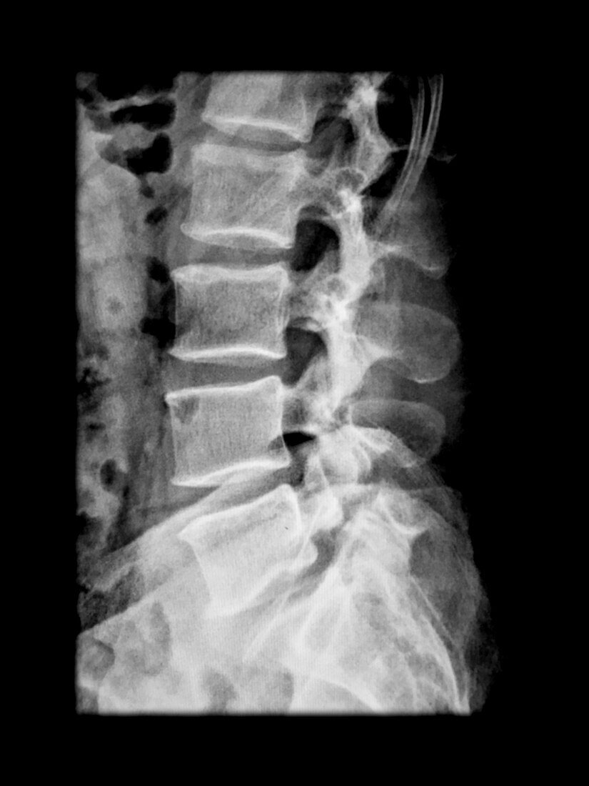 X-ray of Lumbar Spondylolysis L5