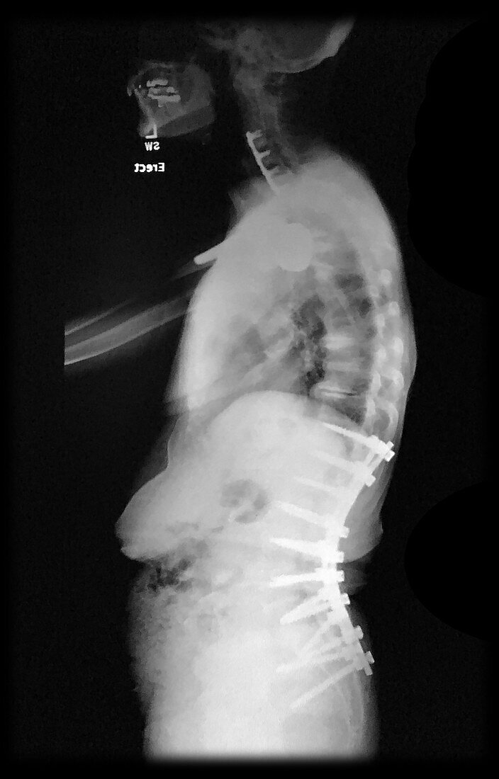 X-ray of Spinal Instrumentation
