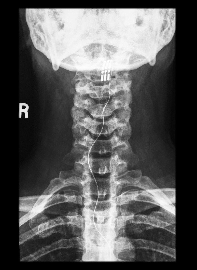 X-ray of Spinal Cord Stimulator