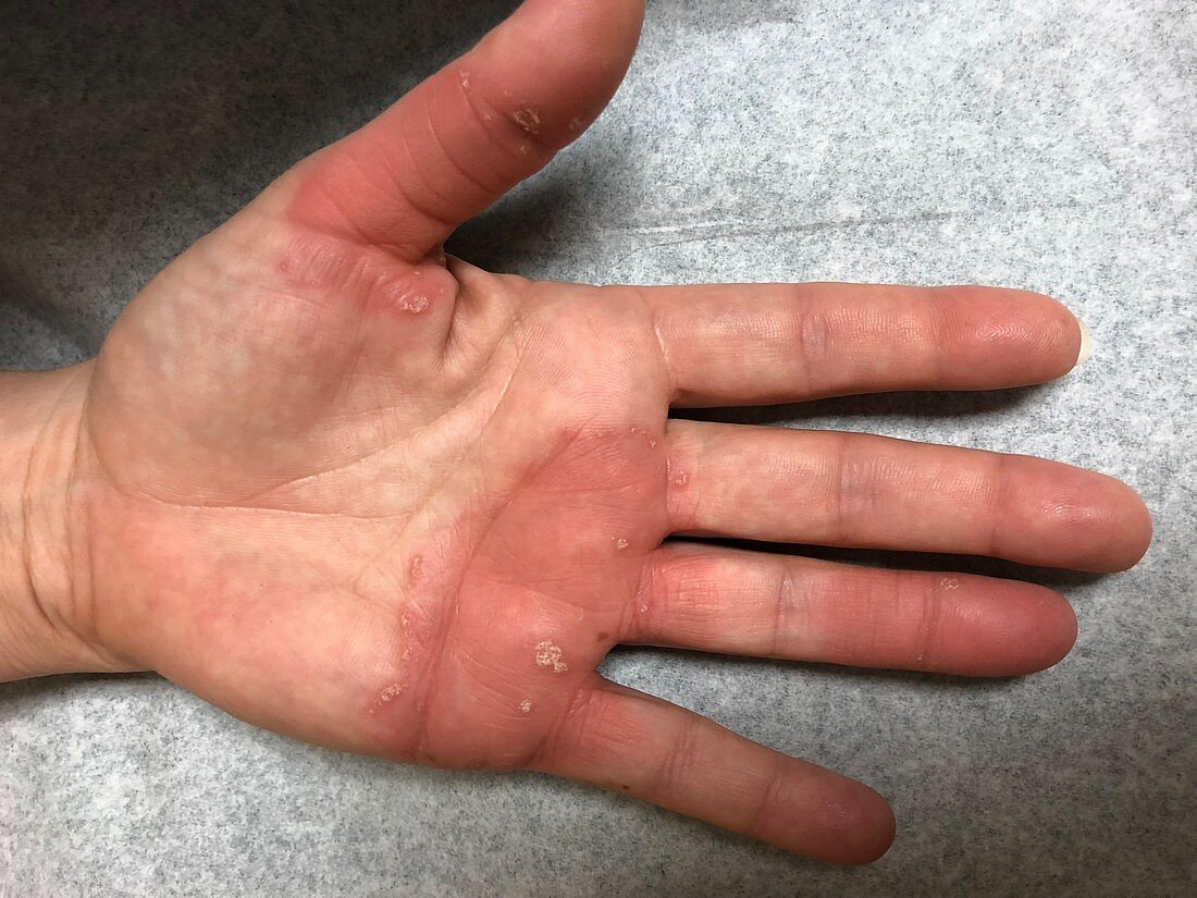 Psoriasis of palm