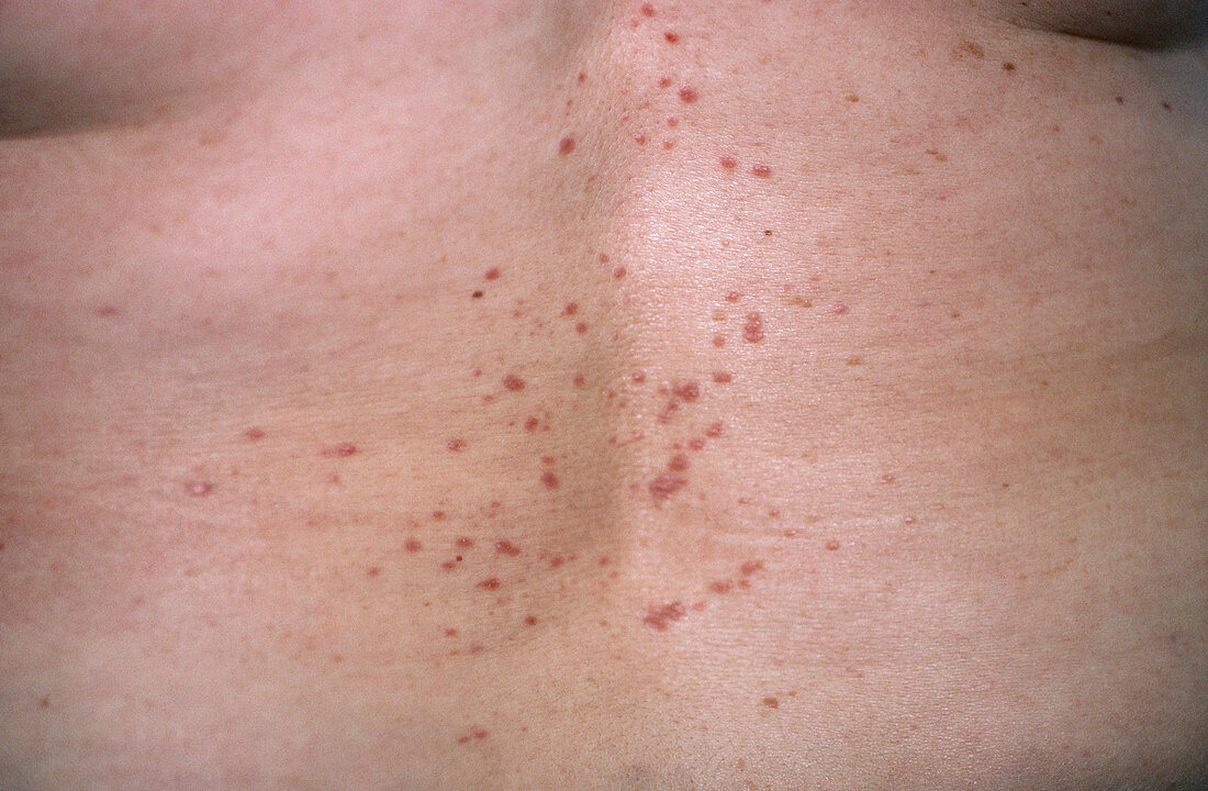 Lichen Planus