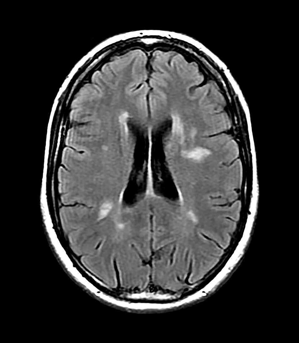 Multiple Sclerosis on MRI