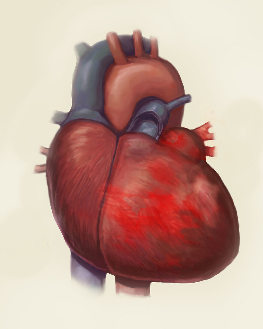 Heart Failure, Illustration