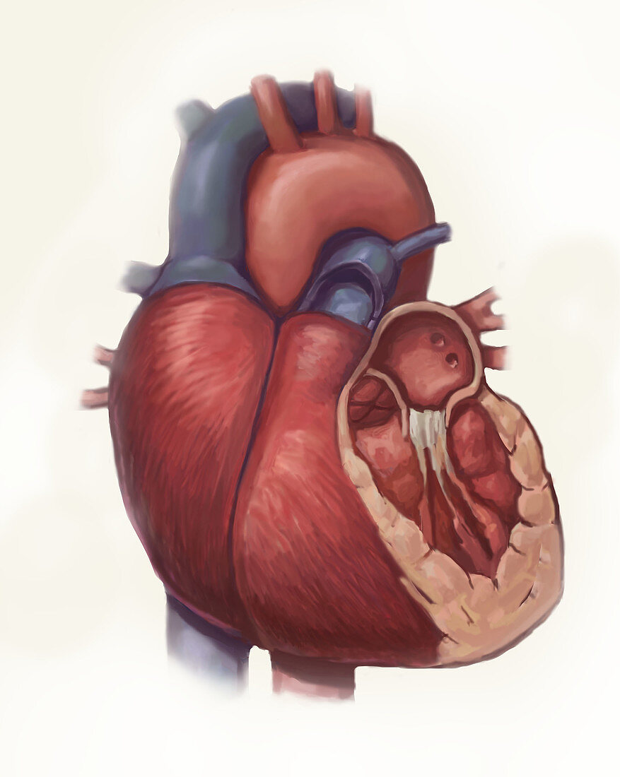 Heart Disease, Illustration