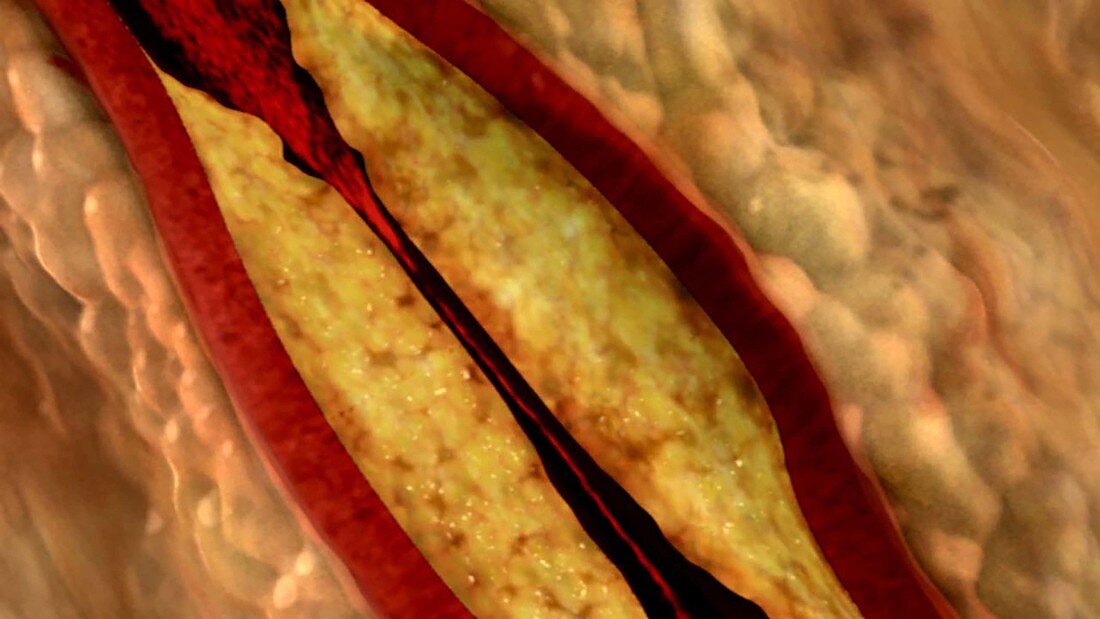 Clogged Coronary Artery