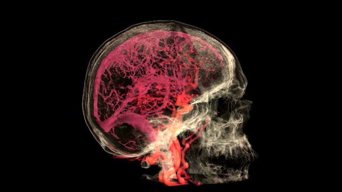 Blood Vessels of the Brain, MRI