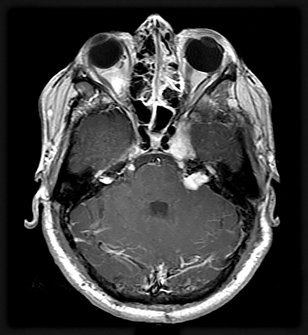 MRI Neurofibromatosis Type 2 (MISME) 7