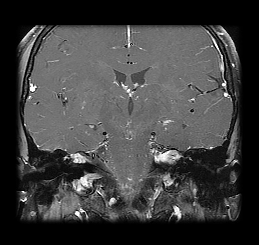 MRI Neurofibromatosis Type 2 (MISME) 5