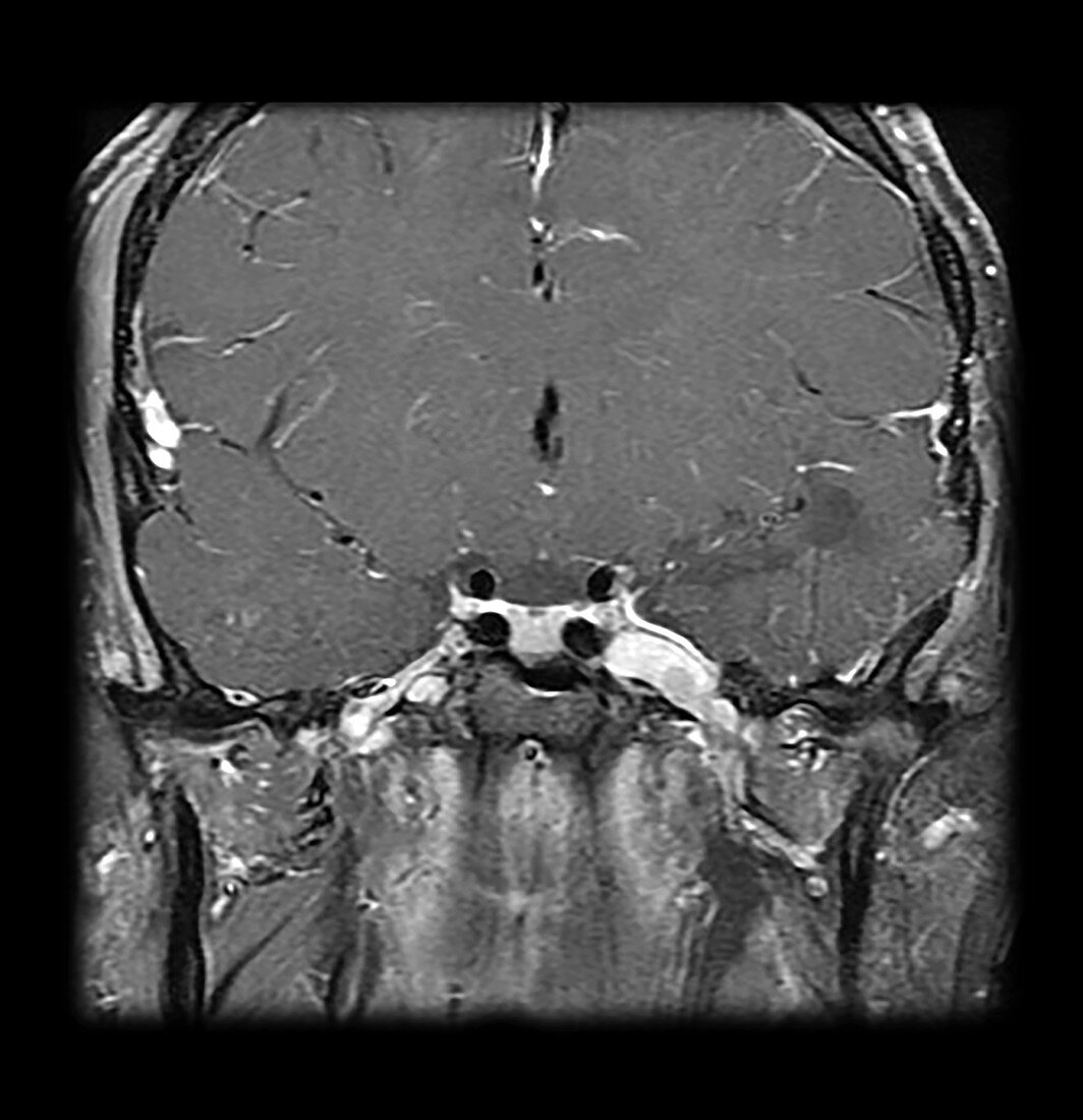 MRI Neurofibromatosis Type 2 (MISME) 3