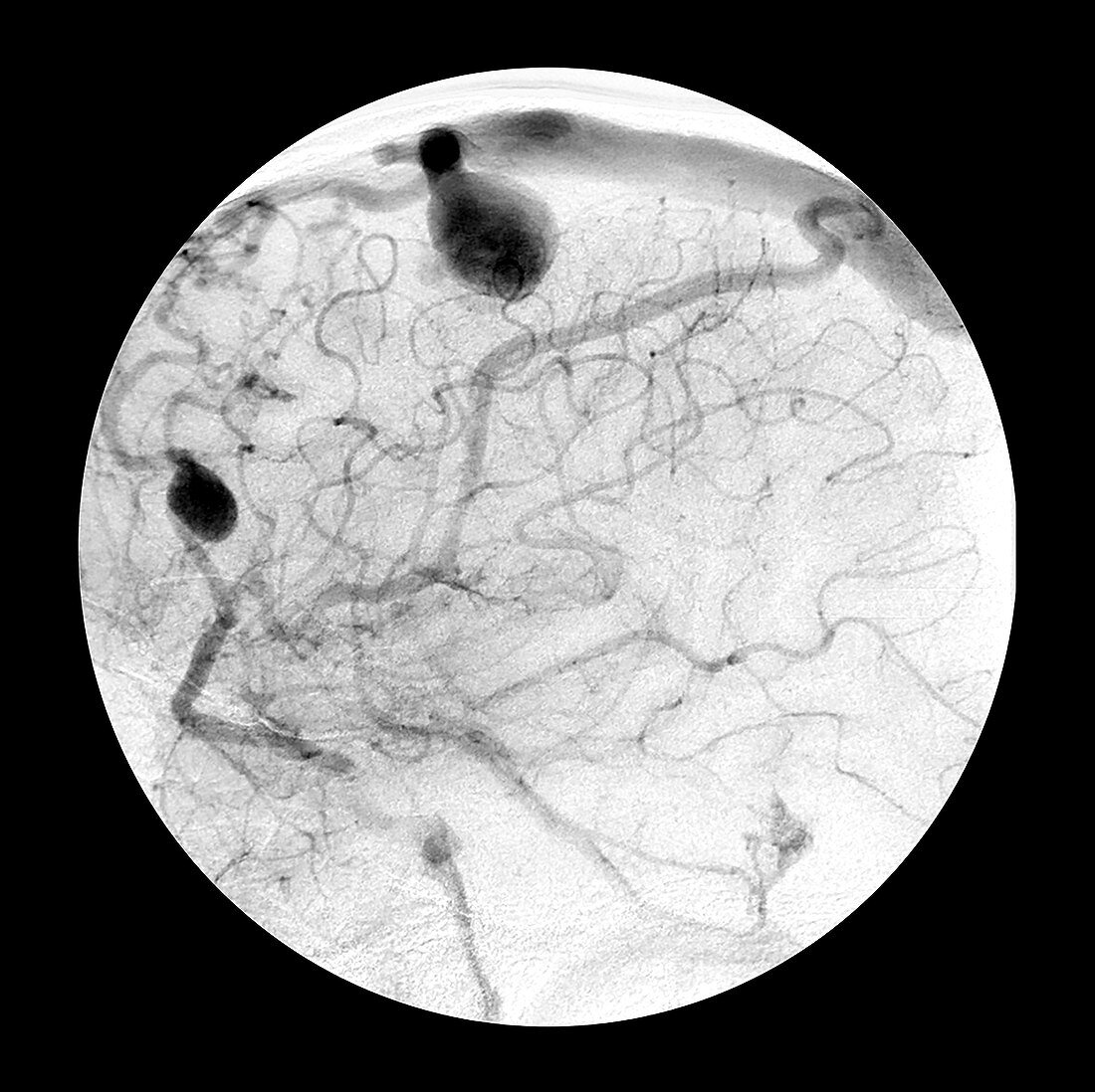 Angiogram of Arterial Venous Fistulas 9