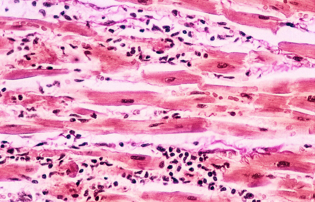 Myocarditis, LM