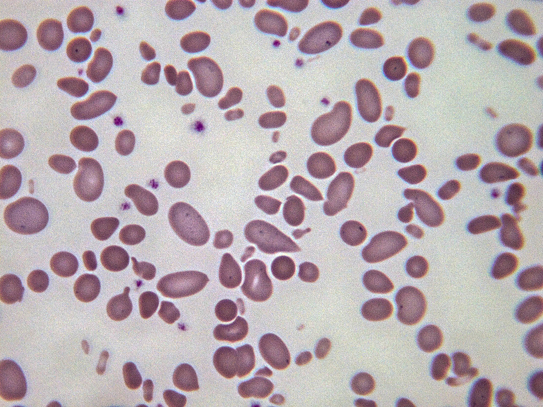 Hereditary pyropoikilocytosis, LM