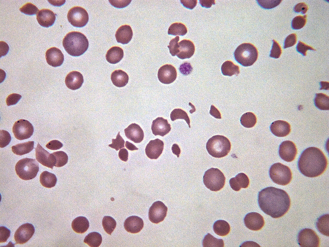 Disseminated intravascular coagulation, LM