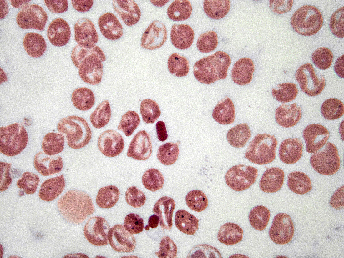 Homozygous haemoglobin E, LM